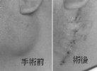 手術前の腫瘍と手術跡